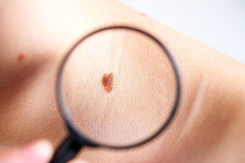 Samo u vremenu za ljeto: 5 pristupačnih načina da se dobije probira za rak kože